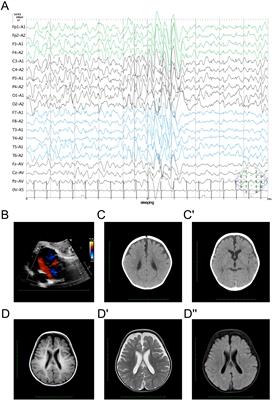 Case report: A novel de novo variant of NACC1 caused epileptic encephalopathy and intellectual disability